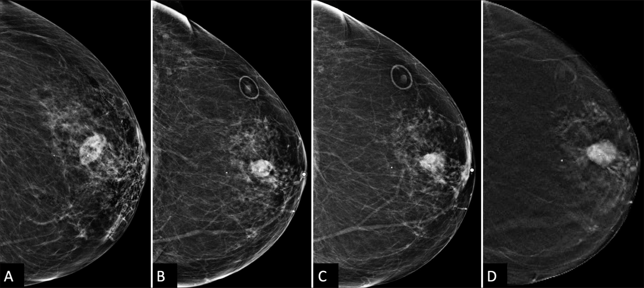 A 66 year old woman’s Post-biopsy changes in the left breast. (A) Immediate post-biopsy CC view shows a 21 mm × 13 mm hematoma and emphysema in the anterior subareolar region. (B) A follow-up mammogram 9 months later shows an interval decrease in the size of the hematoma to 18 mm × 11 mm (white circle depicting skin marker) (C) Six months after that, the hematoma remained stable to minimally increased, measuring 19 mm × 12 mm (also confirmed on sonography, not shown). (D) At the 21-month follow-up, CC tomosynthesis shows an increase in the size of the hematoma to 21 mm × 14 mm with surrounding distortion or spiculations radiating from the mass, raising suspicion and prompting ultrasound-guided biopsy.