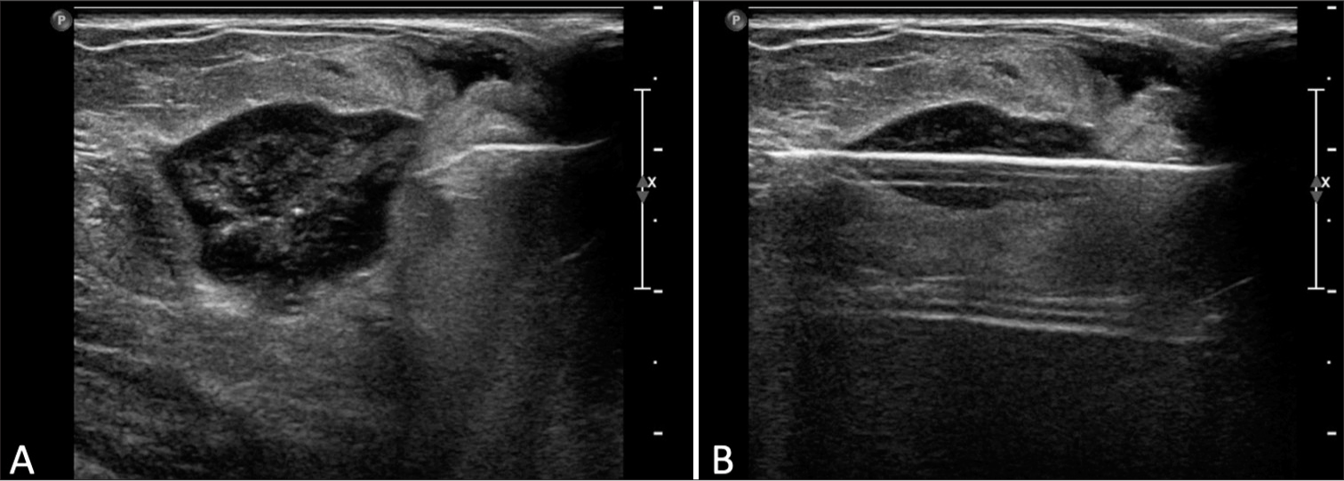 A 66 year old woman’s Ultrasound-guided biopsy of a complex cystic and solid oval mass. (A) Pre-fire ultrasound image shows the mass, representing a post-biopsy hematoma from a previous stereotactic-guided biopsy 21 months earlier. (B) Post-fire image shows appropriate needle placement within the targeted mass.