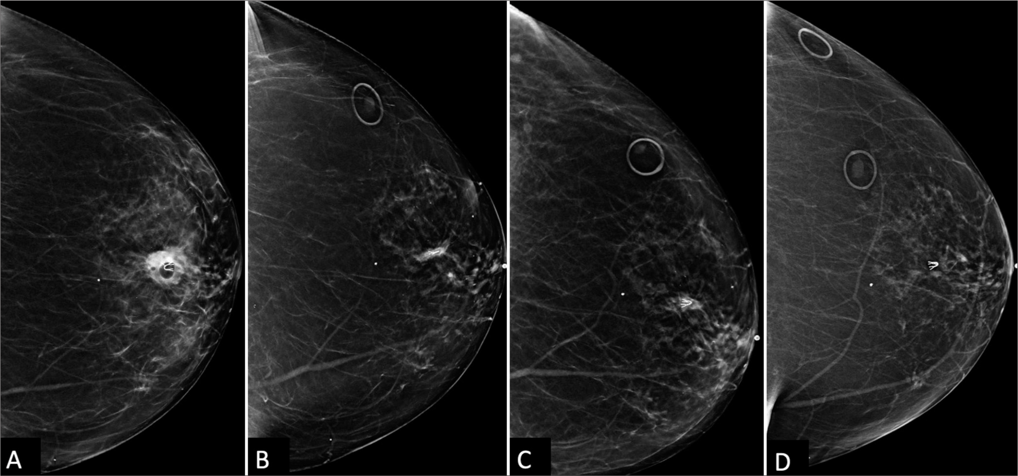 A 66 year old woman’s Post-ultrasound-guided biopsy changes in the left breast. (A) Immediate post-biopsy CC view shows a new U-shaped clip and a minimally decreased hematoma size of 20 mm × 12 mm (white circle). Pathology confirmed granulomatous mastitis (GM). (B) A follow-up mammogram 6 months later shows near complete resolution of the hematoma (white circle) with conservative observation. However, the patient developed skin cellulitis, indicated by the arrow at the area of focal skin thickening at the biopsy site, which resolved with antibiotics. (C) The hematoma and was not seen on the subsequent annual screening mammogram (white circle). (D) The following screening mammogram shows complete resolution of the prior subtle sub-centimeter asymmetry near the U-shaped clip (white circle), confirming biopsy-proven GM.