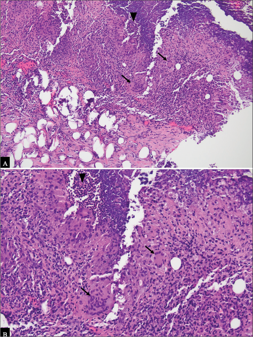 (A) Routine hematoxylin and eosin stain (H&E) section of the lesion at 100× magnification demonstrates a mixed inflammatory lesion, comprised acute black inflammation (black arrowhead) and chronic inflammation with multinucleated giant cells (black arrows). (B) At 200×, the multinucleated giant cells (black arrows) and neutrophils (black arrowhead) are more easily visualized. Gram stain, and acid-fast bacillus stains were negative for bacteria, fungal elements, and acid-fast bacteria, respectively, within the tissue.