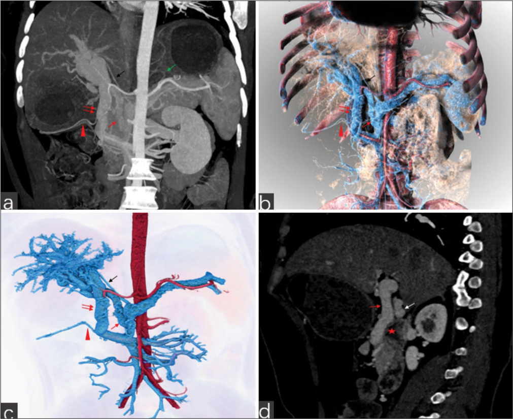 A 26-year-old female patient with gastric volvulus accompanied by portal vein (PV) anomaly. (a-c) Coronal maximum intensity projection and simulated volume rendering images of the computed tomography (CT) showed that the superior mesenteric vein and inferior mesenteric vein formed a common trunk, which then divided into two branches: one ascended into the splenic vein, and the other turned right into the liver (PV1, double red arrows). The splenic vein divided into two branches (PV2, red arrow, PV3, black arrow) at the neck of the pancreas, both entering the liver. The right gastric vein (red triangle) originated from PV1, and the left gastric vein (green arrow) from the splenic vein. (d) The sagittal CT venography showed that the duodenum (red star) is located below PV1 (red arrow) and PV2 (white arrow). PV1 is situated anterior to the duodenum.