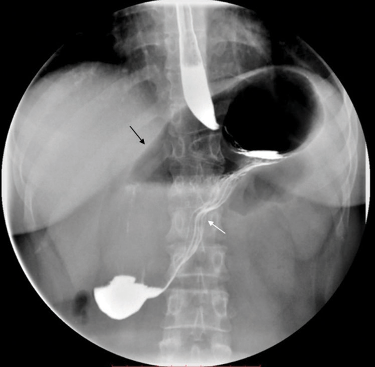 A 26-year-old female patient with gastric volvulus accompanied by portal vein anomaly. The upright filling image of the gastrointestinal contrast showed organoaxial gastric volvulus, with the greater curvature of the stomach (black arrow) positioned upwards and the lesser curvature (white arrow) positioned downwards.