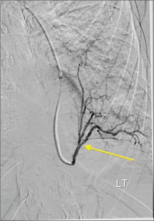 A 53-year-old female with intralobar pulmonary sequestration who presented with cough, shortness of breath, and back pain. Selective digital subtraction angiogram of the first-order aortic branch supplying the left lower lobe sequestration (yellow arrow).