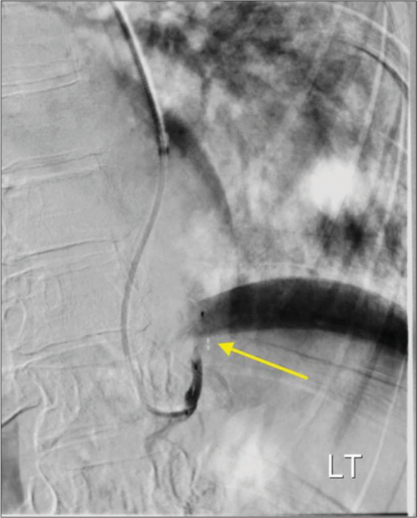 A 53-year-old female with intralobar pulmonary sequestration who presented with cough, shortness of breath, and back pain. Post-embolization digital subtraction angiogram shows successful embolization (yellow arrow).