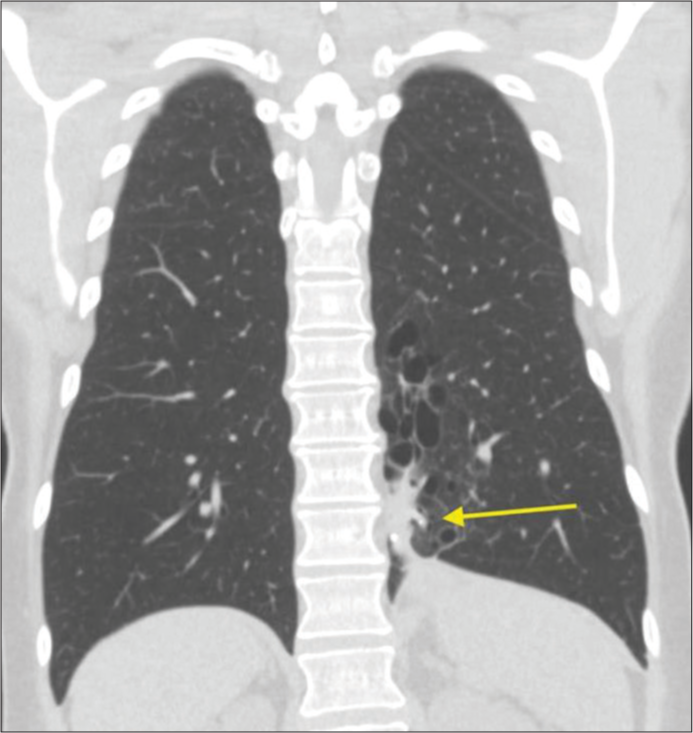 A 53-year-old female with intralobar pulmonary sequestration who presented with cough, shortness of breath, and back pain. Nine-month follow-up coronal computed tomography chest without contrast demonstrates the significant decrease in the extent of the sequestration (yellow arrow), as well as decreased interaction with the underlying diaphragm.