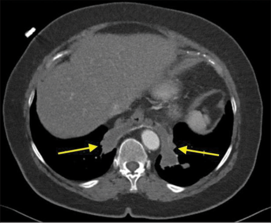 A 70-year-old female with bilateral intralobar pulmonary sequestration who presented with progressive cough with hemoptysis. Initial axial computed tomography angiogram of the chest demonstrates the intralobar pulmonary sequestration (yellow arrows).