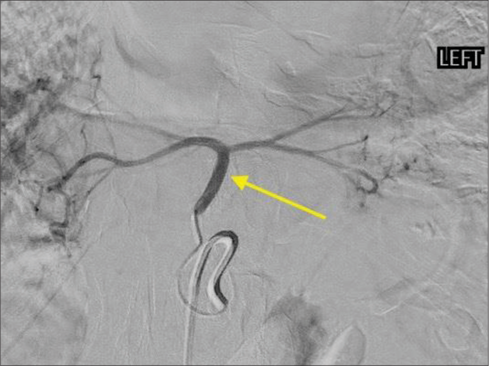 A 70-year-old female with bilateral intralobar pulmonary sequestration who presented with progressive cough with hemoptysis. Digital subtraction angiogram from the left gastric artery demonstrates the segmented arterial supply (yellow arrow).