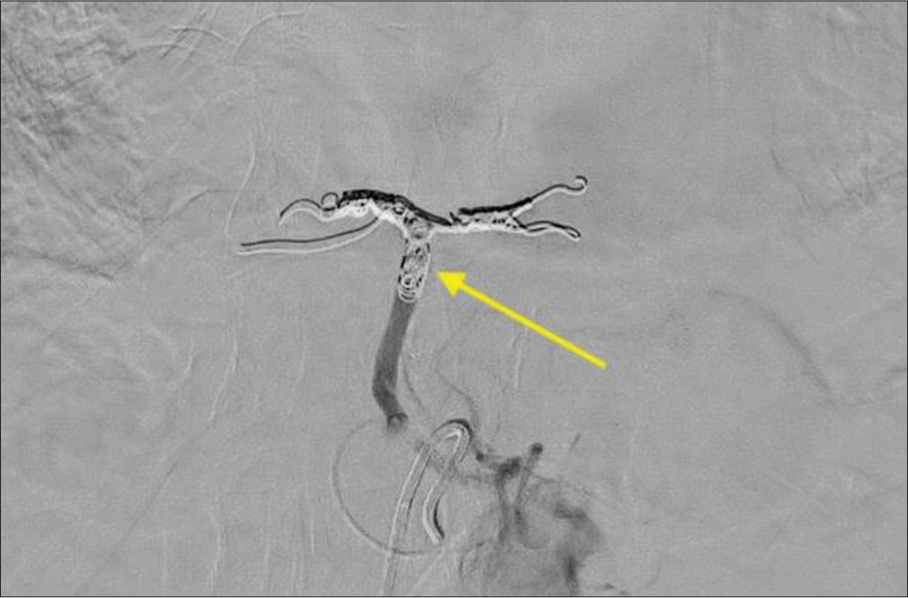 A 70-year-old female with bilateral intralobar pulmonary sequestration who presented with progressive cough with hemoptysis. Post-embolization digital subtraction angiogram from the celiac axis demonstrates cessation of flow to the sequestration (yellow arrow).