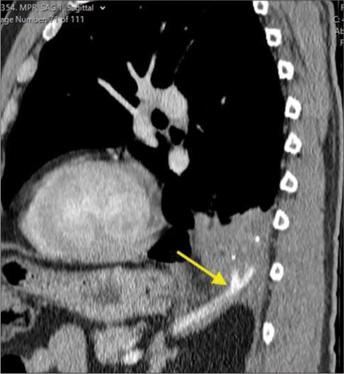 A 70-year-old male with intralobar pulmonary sequestration who presented with sub-massive hemoptysis. Contrast-enhanced sagittal computed tomography chest demonstrates a large caliber vessel with 2 dominant branches supplying the sequestration (yellow arrow).