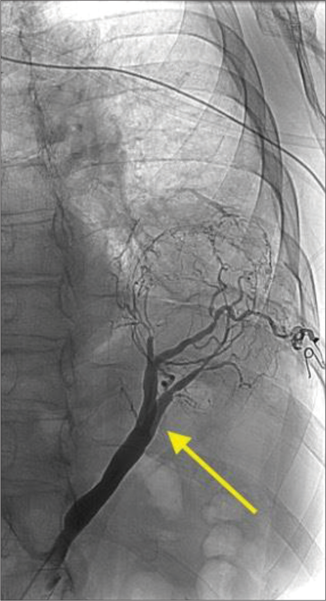 A 70-year-old male with intralobar pulmonary sequestration who presented with sub-massive hemoptysis. Digital subtraction angiogram demonstrates arterial inflow supplying the pulmonary sequestration (yellow arrow).