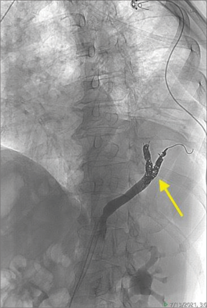 A 70-year-old male with intralobar pulmonary sequestration who presented with sub-massive hemoptysis. Post-embolization digital subtraction angiogram shows successful embolization (yellow arrow) with sparing of the vessel trunk to facilitate cross-clamping during future resection.