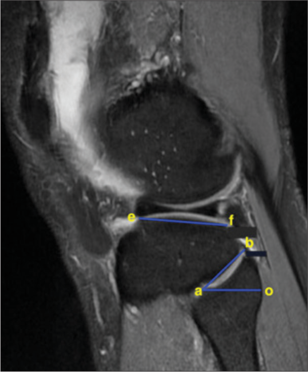 Methodology of determining the proximal tibiofibular joint inclination angle in the sagittal plane based on T1-weighted magnetic resonance image: e, f – points connecting the anterior and posterior horns of the lateral meniscus at the level of the tibial plateau, a – the most anteriorly positioned point of the tibial surface, and b – the most posteriorly positioned point of the tibial surface. Line |ef| must be parallel to the tibial plateau, and line |ao| must be parallel to line |ef|.