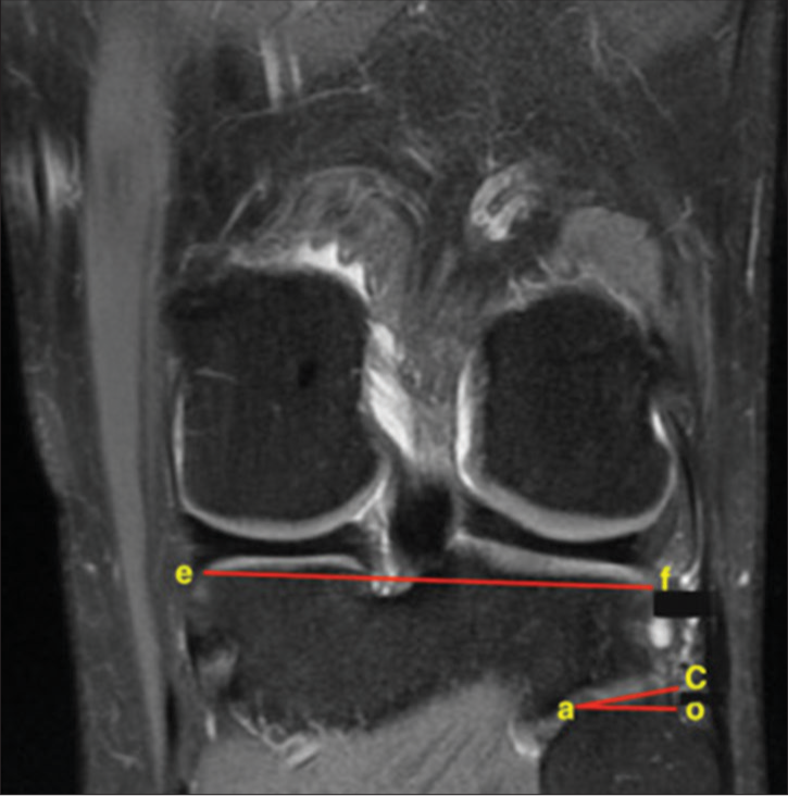 Methodology of determining the proximal tibiofibular joint inclination angle in the coronal plane based on T1-weighted magnetic resonance image: C – the most laterally located point of the articular surface of the tibiofibular joint on the tibial side; a – the most medially located point of the articular surface of the tibiofibular joint on the tibial side; e – the lateral apex of the tibial plateau; f – the medial apex of the tibial plateau. Line |ao| must be parallel to |ef|.