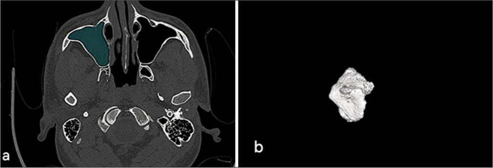 (a) Demonstrates the use of philips intelispace 3D segmentation software for calculating the volume of the left maxillary sinus, highlighting area of opacification. (b) Presents a 3D visualization of the sinus cavity.