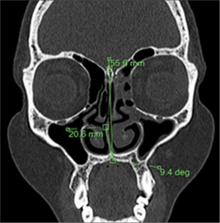 Coronal computed tomography scan illustrating the technique used to measure the degree of nasal septal deviation.