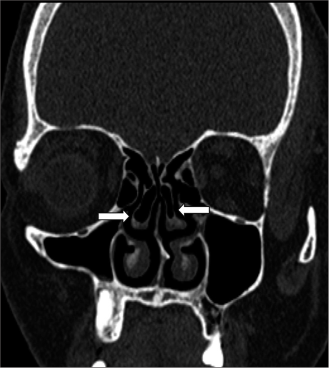 Coronal computed tomography scan showing bilateral concha bullosa (white arrows).