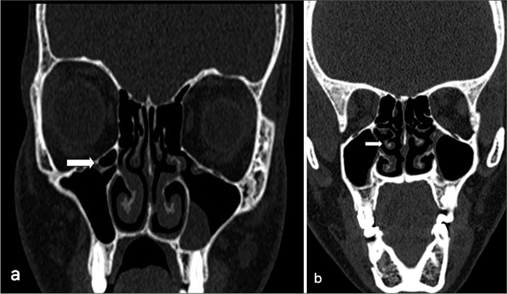 (a) Coronal computed tomography (CT) scan displaying a right Haller cell with polypoidal mucosal thickening of the left maxillary sinus (white arrow indicates Haller cell). (b) Coronal CT scan displaying a right paradoxical middle turbinate (white arrow indicates the paradoxical middle turbinate).