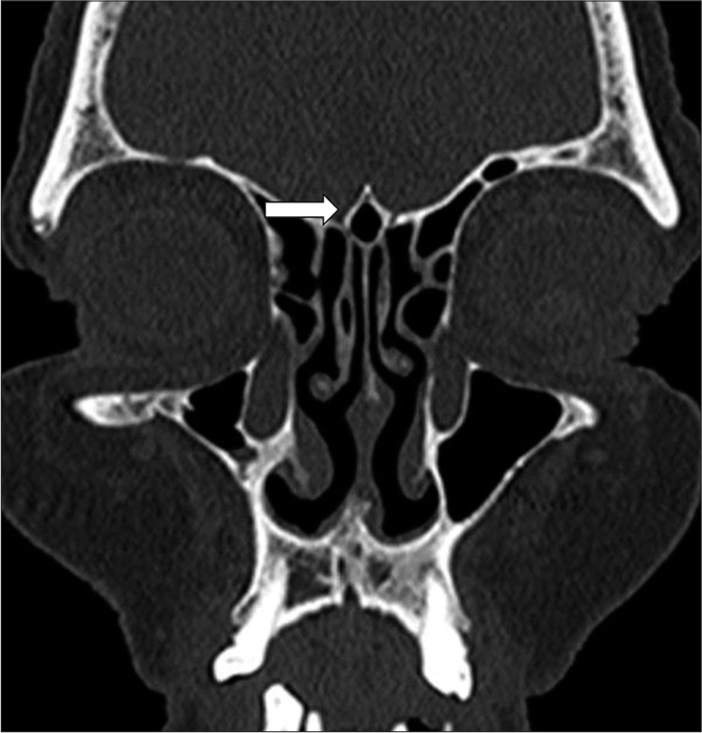 Coronal computed tomography (CT) scan showing a pneumatized crista galli (wishbone) (white arrow indicates the pneumatized crista galli).