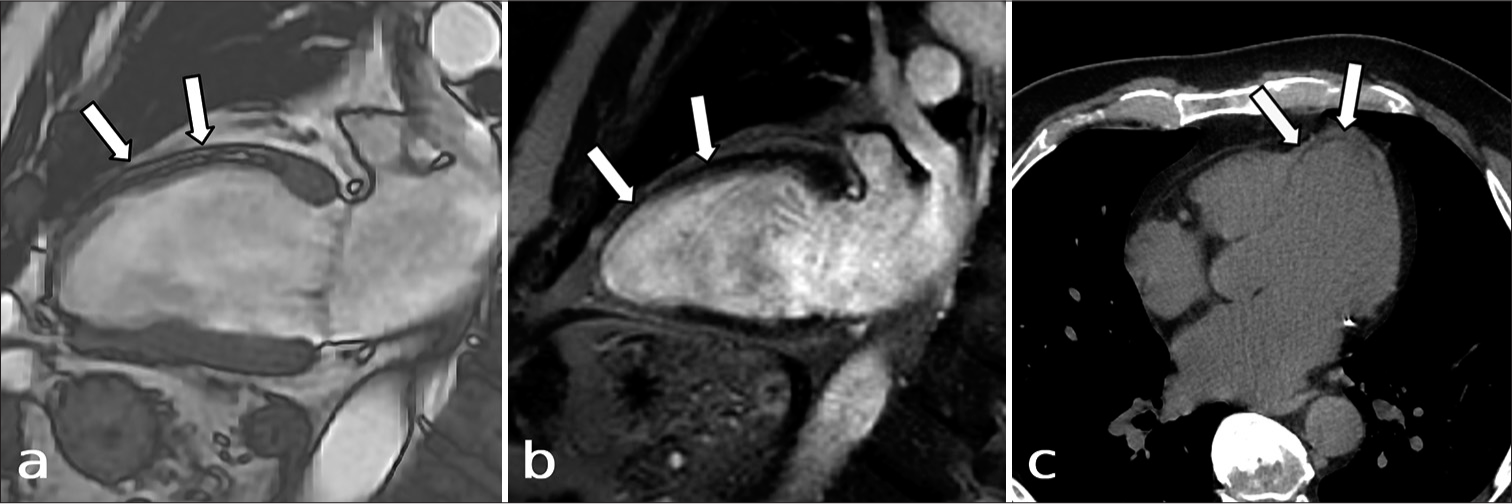 A 64-year-old male undergoing work-up for revascularization. (a) The balanced steady-state free precession, 2-chamber view shows a “double-line” sign (white arrows), as may be seen in the setting of lipomatous metaplasia, and is caused by chemical shift artifact surrounding the area of infarction when fat is present. (b) This is also seen in the corresponding phase sensitive inversion recovery, 2-chamber view with late gadolinium enhancement throughout the wall (white arrows). (c) This is also evident as an area of low attenuation on CT (white arrows), corresponding to the area of wall thinning on the cardiac MRI, consistent with a chronic myocardial infarction.