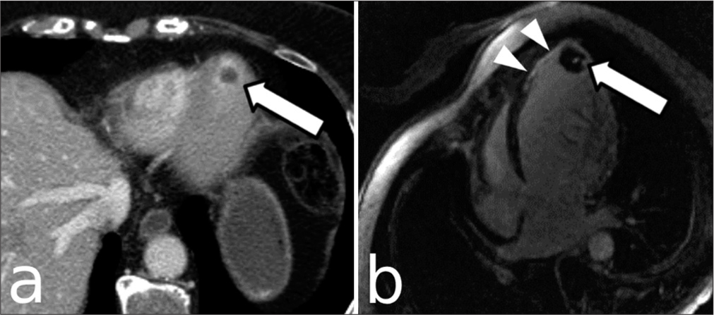 A 73-year-old male with acute presentation to the emergency department for failure to thrive. (a) Apical thrombus is noted within the left ventricle on conventional, non-gated, non-cardiac CT (white arrow). (b ) Oblique, 4 chamber, phase sensitive inversion recovery cardiac MR demonstrates an LAD territory area of late gadolinium enhancement (white arrowheads). The apical thrombus is more clearly seen as well (white arrow).