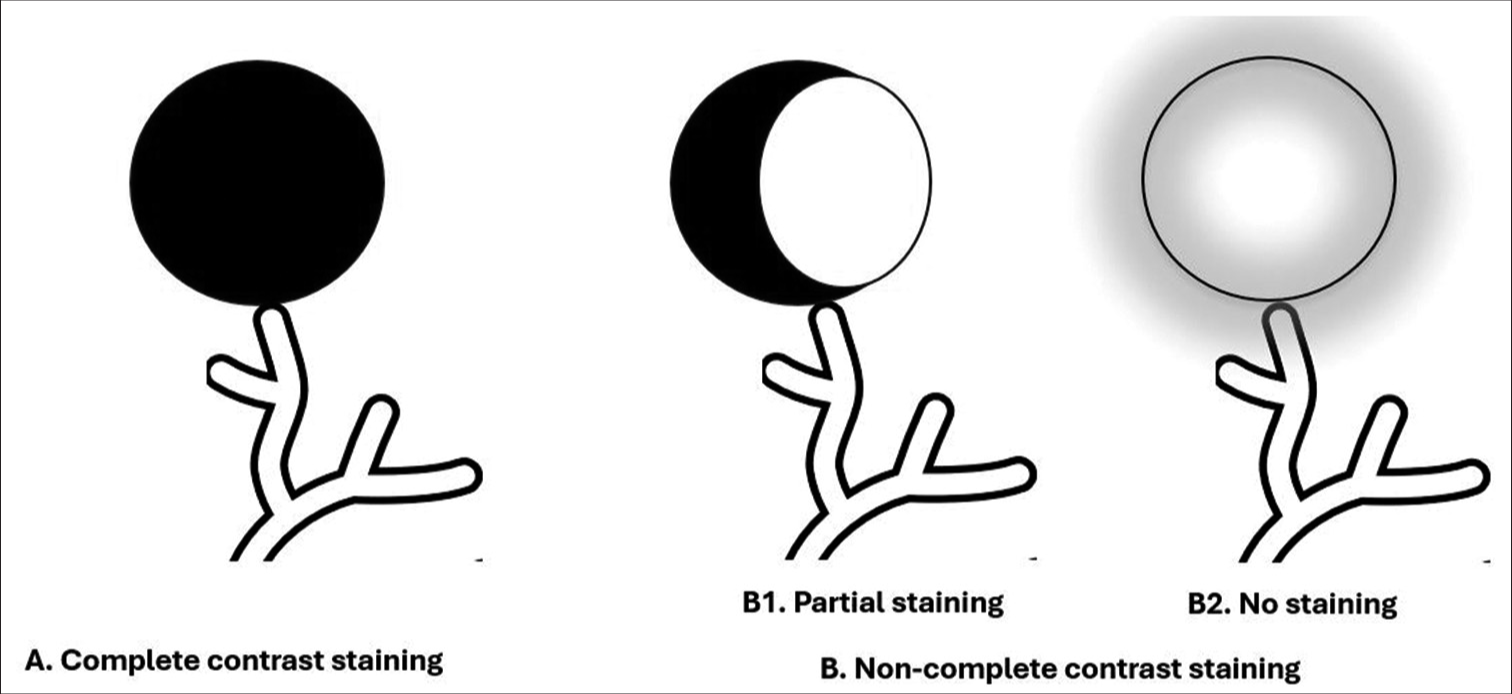 Diagram of hepatocellular carcinoma contrast staining during transarterial drug-eluting beads chemoembolization. (A) Complete contrast staining, (B) Non-complete contrast staining, (B-1) Partial staining, (B-2) No staining.