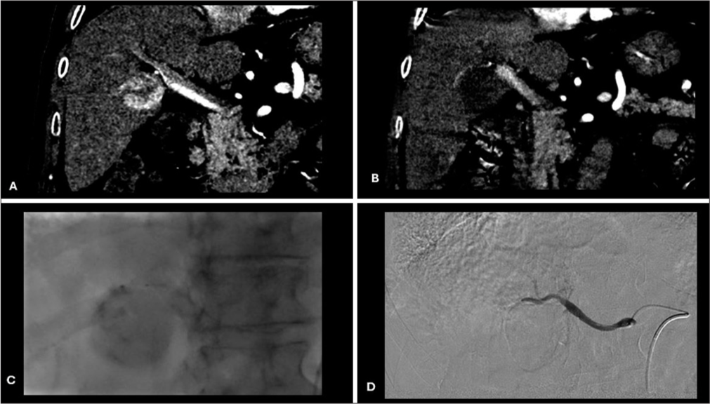 Pretreatment, intraprocedural, and post-treatment imaging. (A) Pretreatment CT postcontrast coronal image showing HCC in right liver lobe; (B) post-treatment CT postcontrast coronal image showing a complete response of HCC; (C) intraprocedural fluoroscopy image showing a complete contrast staining of HCC during DEBTACE; and (D) intraprocedural DSApost chemoembolization image showing no post treatment contrast uptake. (CT: Computed tomography, HCC: Hepatocellular carcinoma, DEBTACE: Drug-eluting bead transarterial chemoembolization, DSA: Digital subtraction angiography).