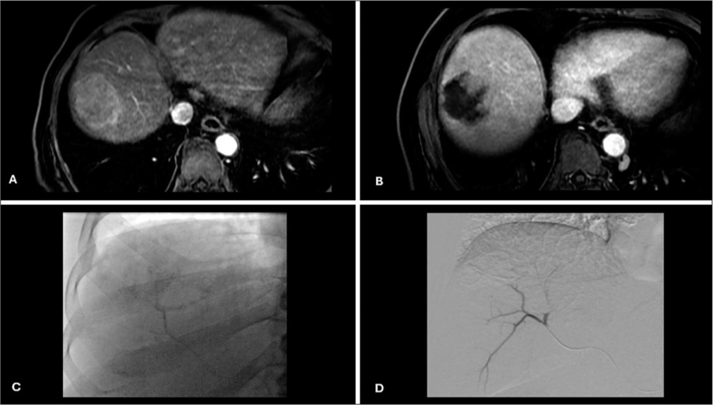 Pretreatment, intraprocedural, and post-treatment imaging. (A) Pretreatment CT postcontrast axial image showing HCC in right liver lobe; (B) Post-treatment CT postcontrast axial image showing a partial response of HCC; (C) Intraprocedural fluoroscopy image showing a non-complete contrast staining of HCC during DEBTACE; (D) Intraprocedural DSApost chemoembolization image showing no post-treatment contrast uptake. (CT: Computed tomography, HCC: Hepatocellular carcinoma, DEBTACE: Drug-eluting bead transarterial chemoembolization, DSA: Digital subtraction angiography).