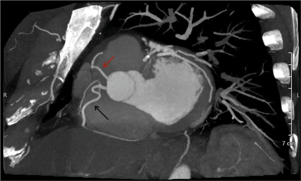 Maximum intensity projection computed tomography coronary angiography image showing the two separate ostia of the right coronary artery (black arrow) and the right left anterior descending (red arrow).