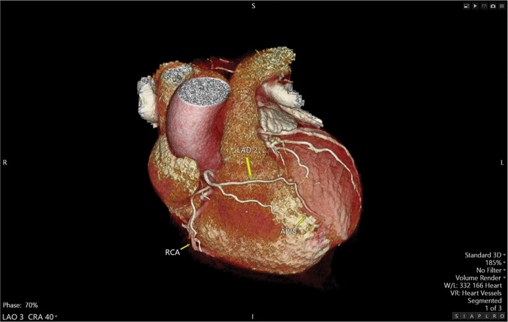 Three-dimensional volume rendered computed tomography coronary angiography image shows the right left anterior descending arising from the right coronary cusp traverses to the left side anterior to the right ventricular outflow tract and terminates in the distal anterior interventricular sulcus. (LAD2 (yellow arrow): Long left anterior descending artery, RCA (yellow arrow): Right coronary artery, AIVS (yellow arrow): Anterior interventricular sulcus).