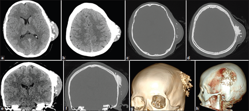 Axial and coronal computed tomography (CT) brain and bone window with 3D reconstruction showing a 2.5 × 5 × 5 cm extracranial heterogeneous mass with a soft-tissue component and hyperdense calcification based on the left parietal bone. The lesion did not invade the diploe. Brain CT angiography (CTA) showing blood supply from temporal artery branch. (a and b) Axial CT brain window. (c and d) Axial CT bone window. (e and f) Coronal CT brain and bone window. (g) 3D reconstruction. (h) CTA.