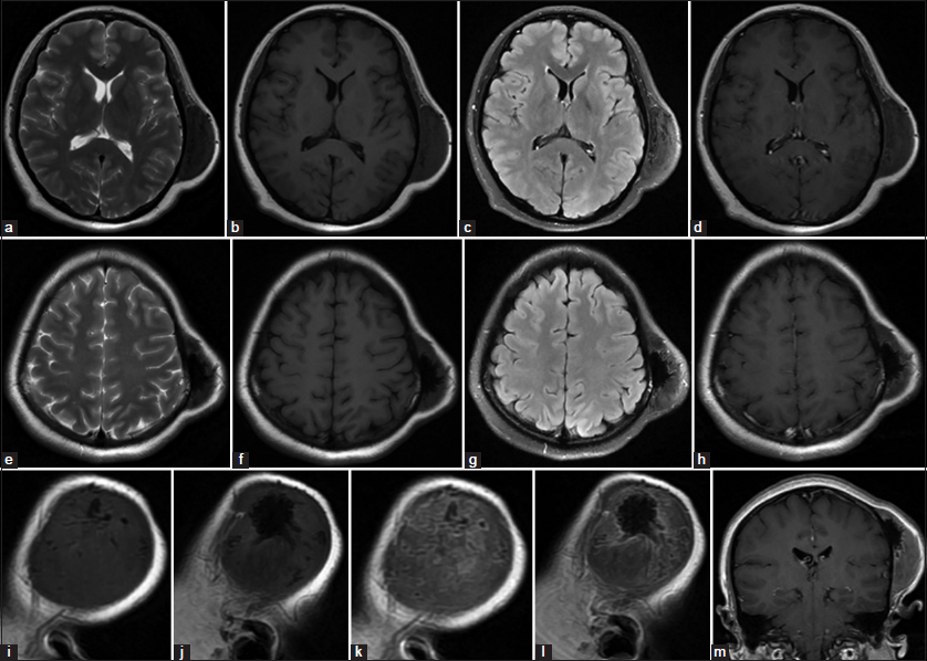 Magnetic resonance imaging of the brain revealing a heterogeneous mass based on the left parietal bone that was isointense on T1-weighted image and slightly hypointense on T2-weighted image, and inhomogeneously progressive enhanced on postcontrast T1-weighted image. The multiple hypointense areas in the central regions of the lesion on T1 and T2-weighted images suggested calcification. (a-d) T2W, T1W without contrast, T2 weighted-Fluid-attenuated inversion recovery (T2-FLAIR) and T1W with gadolinium mid-axial image. (e-h) T2W, T1W without contrast, T2-FLAIR and T1W with gadolinium upp-axial image. (i and j) T1W sagittal image without contrast. (k and l) T1W sagittal image with gadolinium. (m) T1W coronal image with gadolinium.