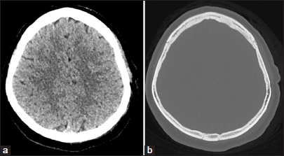 Post-operative axial computed tomography (CT) brain and bone window showing complete excision of the lesion and curettage of the attached part of skull. (a) Axial CT brain window. (b) Axial CT bone window.