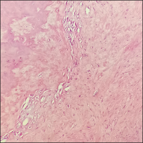 Hematoxylin and eosin staining showing spindle and star shaped fibroblasts within abundant collagen or collagen myxoid stroma background, with sparse blood vessels and no obvious cellular atypia or nuclear division (magnification, ×200).