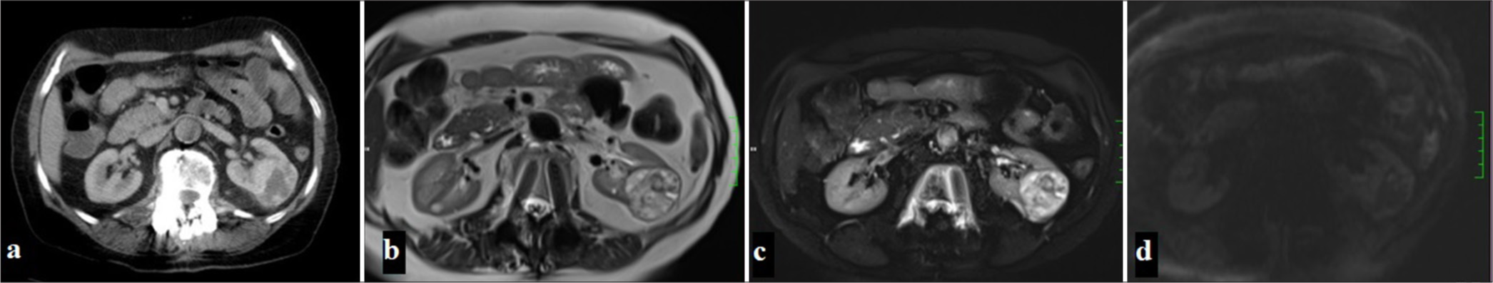 (a) A 65-year-old woman with a mass in the left kidney observed on CT in the portal phase, (b) On MRI, the mass appears heterogeneously hyperintense on T2-weighted and fat-suppressed T2-weighted images,(c) while areas within the mass demonstrate focal diffusion restriction on diffusion-weighted imaging (DWI) (d) and apparent diffusion coefficient (ADC) maps.