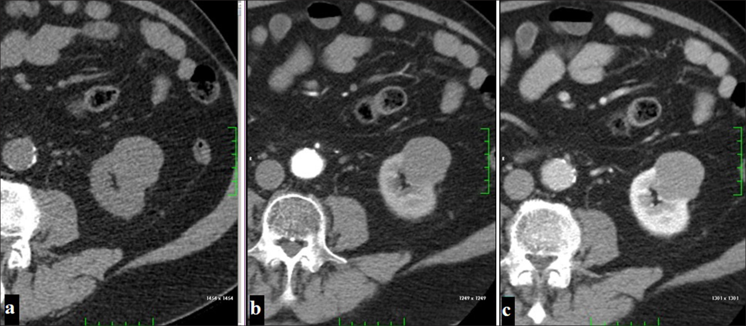 A 54-year-old man with a localized exophytic mass lesion in the left kidney, showing no significant contrast enhancement (a) on the pre-contrast phase, (b) corticomedullary phase, (c) nephrogenic phase images (Papillary renal cell carcinoma).