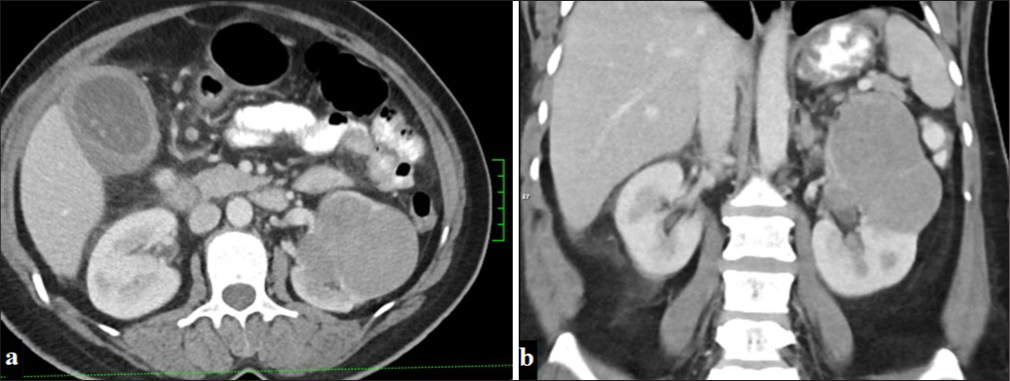 A 53-year-old woman with a mass lesion in the upper pole of the left kidney, displaying macrolobulated contours and minimal contrast enhancement in the portal phase on (a) axial and (b) coronal planes on CT (Chromophobe renal cell carcinoma).