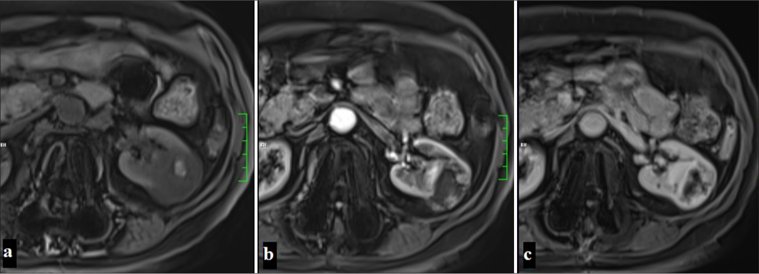 A 60-year-old woman with a lesion observed as hypointense compared to the renal parenchyma in precontrast fat-suppressed T1-weighted imaging, containing a hyperintense area suggestive of focal hemorrhage. The mass shows contrast enhancement except for the central cystic areas in the corticomedullary phase and nephrogenic phase on dynamic MR examination, displayed sequentially in the images (Clear cell renal cell carcinoma).