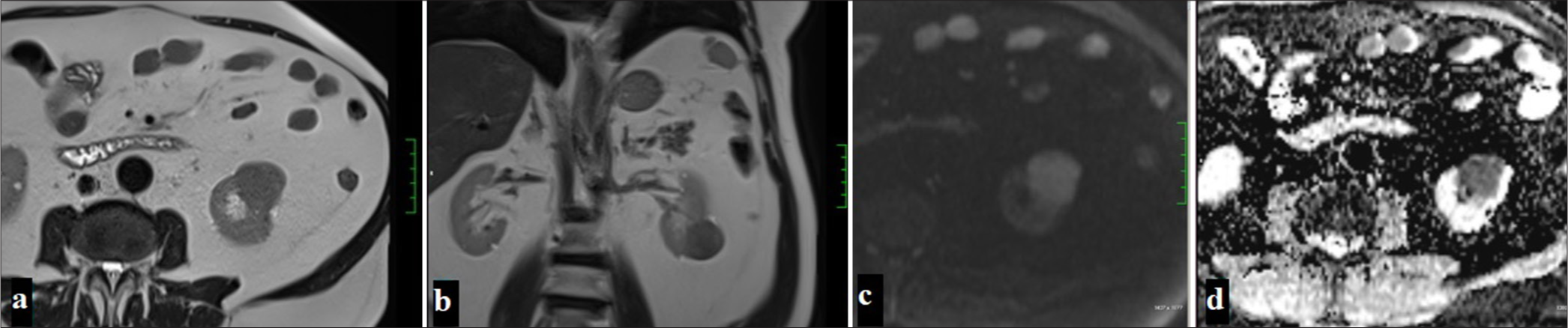 A 54-year-old man with a lesion observed as hypointense in T2-weighted imaging on axial (a) and coronal (b) planes on MRI, hyperintense on DWI (c), and showing diffusion restriction suggestive of malignancy on ADC (d) (Papillary renal cell carcinoma).