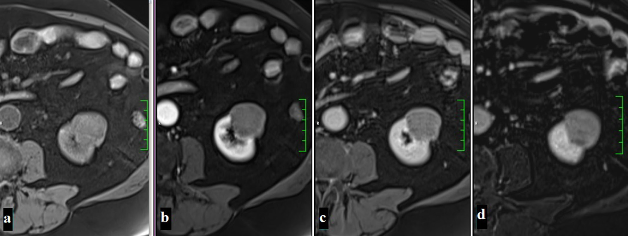 A 54-year-old man with a lesion observed as hypointense in precontrast fat-suppressed T1-weighted imaging (a), showing no significant contrast enhancement in the corticomedullary phase (b) and nephrogenic phase (c), with the subtraction image (d) confirming the absence of contrast enhancement (Papillary renal cell carcinoma).