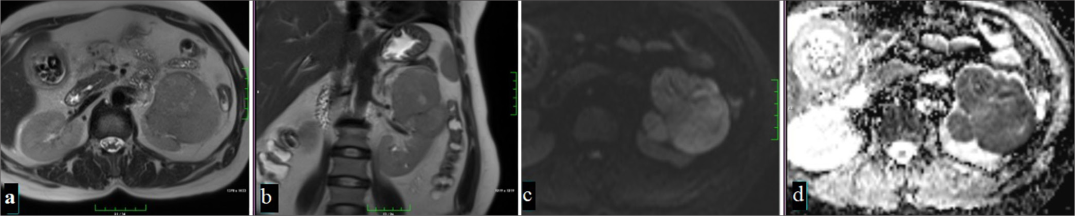 A 53-year-old woman with a mass that is iso-hypointense compared to the renal parenchyma in T2-weighted imaging on axial (a) and coronal (b) planes on MRI, with focal hyperintense areas noted sporadically. The mass is observed to be hyperintense on DWI (c) and shows diffusion restriction suggestive of malignancy on ADC (d) (Chromofobe renal cell carcinoma).