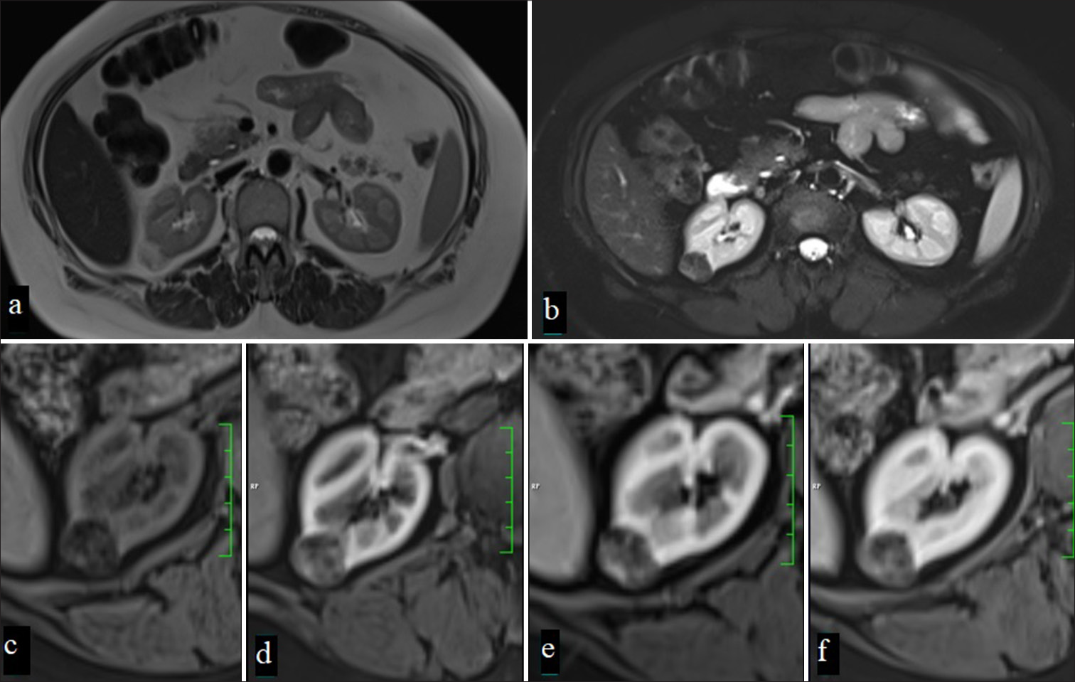 A 67-year-old man with a mass lesion in the right kidney, which appears hyperintense on T2-weighted imaging (a) and shows significant signal loss on fat-suppressed T2-weighted imaging (b) due to macroscopic fat content. In dynamic MRI, the lesion, heterogeneously hypointense compared to the renal parenchyma on precontrast fat-suppressed T1-weighted imaging (c), shows moderate contrast enhancement in the corticomedullary phase (d), nephrogenic phase (e), and (f) late phases (Angiomyolipoma).