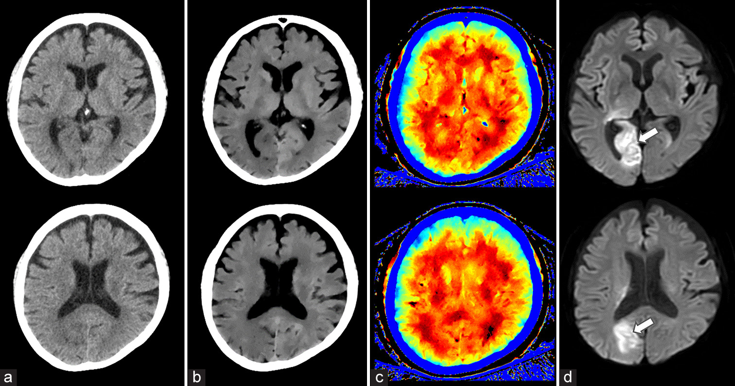 A 69-year-old woman with acute ischemic stroke (AIS) in the right occipital lobe. (a) 120 kVp images, (b) ED images, (c) effective Z images, (d) MRI images. Diffusion-weighted MRI revealed an abnormal signal (arrow) in the right occipital lobe. The lesion was poorly visualized on the conventional 120-kVp image but was clearly identifiable on ED imaging. Effective Z imaging demonstrated only a slight difference between the left and right occipital lobes.