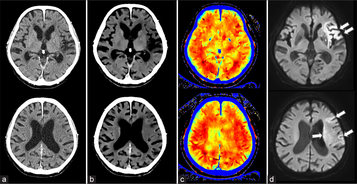 A 93-year-old man with acute ischemic stroke (AIS) in the left middle cerebral artery territory. (a) 120 kVp images, (b) ED images, (c) effective Z images, (d) MRI images. Diffusion-weighted MRI revealed an abnormal signal (arrow) in the left middle cerebral artery. The lesion was poorly visualized on the conventional 120-kVp image but was clearly identifiable on ED imaging. Effective Z imaging showed a discernible difference between the left and right sides.