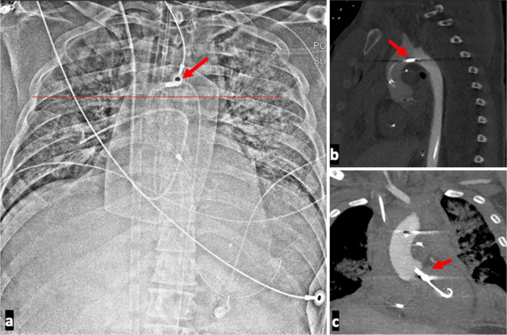 A 39-year-old male presenting with cardiac arrest with ST-elevation myocardial infarction with unstable hemodynamics placed on Impella support and found to have a high Impella positioning. (a) Chest radiograph of high positioned Impella. The outlet port, indicated by the red arrow, can be seen in the aortic arch indicating a malposition. (b) Associated sagittal computed tomography shows the outlet port in the aortic arch as indicated by the red arrow. The outlet of the device should be in the ascending aorta. (c) Associated coronal CT shows the inlet port at the level of the aortic valve plane as indicated by the red arrow. The pigtail end of the Impella is likely in the sub-mitral chordal apparatus. Echo reported as distance of 1.5 cm form the aortic valve plane confirming. A suboptimal position. The lack of opacification of the left ventricle on this contrast enhanced computed tomography angiography is due to reversed contrast flow direction in the aorta as the patient was also on a peripheral venoarterial extracorporeal membrane oxygenation (VA ECMO).