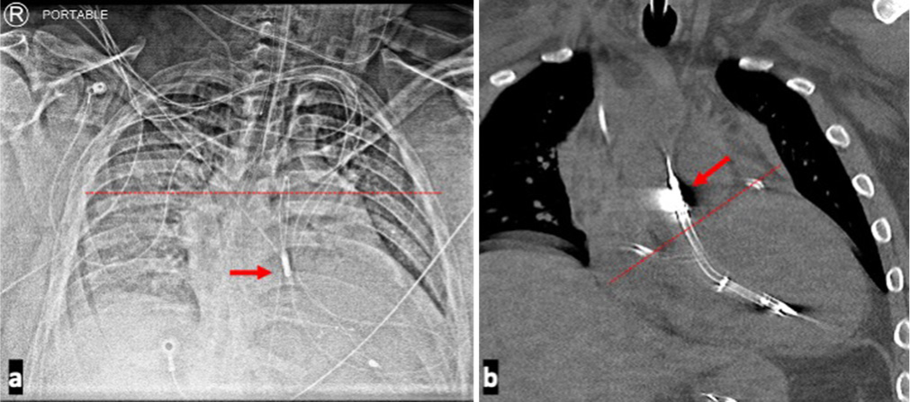 A 35-year-old male presenting with non-ST-elevation myocardial infarction complicated by cardiogenic shock requiring Impella support and found to have a Low Impella positioning. Imaging modalities demonstrating low Impella positioning. (a) Chest radiograph shows the level of the carina indicated by the dotted line, while the arrow demarcates the Impella outlet below the carina. Significant distance between the carina and Impella outlet port should raise the suspicion for a lower Impella placement. (b) Coronal computed tomography image of the patient shows outlet port of the Impella device, indicated by the red arrow, very proximal to the marked level of the aortic valve plane which is marked by the dotted line. The inlet port is deep within the left ventricle.