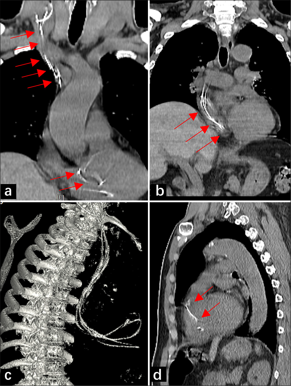 A 67-year-old man’s head and thoracic computed tomography (CT) scan, taken 2 months after the initial ventriculoperitoneal (VP) shunt surgery. (a and b) show coronary CT images demonstrating the migration of the VP shunt catheter through the jugular vein and superior vena cava into the right heart (solid red arrow). (c) shows a maximum intensity projection reconstruction of the migrated VP shunt catheter. (d) displays a sagittal CT image showing the tip of the migrated catheter located in the pulmonary artery trunk (solid red arrow).
