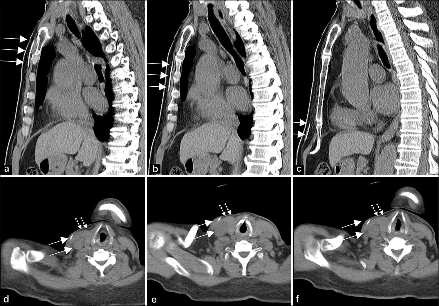 A 67-year-old man’s head and thoracic computed tomography scan after the second ventriculoperitoneal (VP) shunt surgery. (a-c) show the course of the VP shunt catheter along the stern-abdominal wall (solid white arrow). (d-f) depict the normal position of the catheter, which is not in the right internal jugular vein (solid white arrow) and clearly delineates the sternocleidomastoid muscle (dashed white arrow).