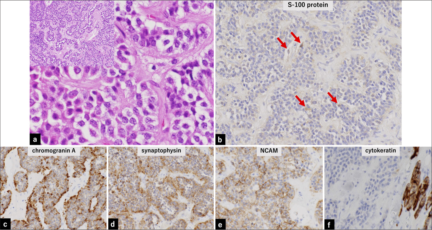 Pathological findings. (a) Hematoxylin- and eosin-stained histopathology samples. Tumor cells are arranged in a spore-like or cord-like pattern (Zellballen), with a relatively wide fibrous stroma (left upper, ×10). Tumor cells exhibit homogeneous round nuclei and acidophilic cytoplasm (×40 magnification). (b) Immunopathology samples showing partial positivity (red arrow) for S-100 in sustentacular cells at the nest margins and negativity for tumor cells and stroma in the resected sample (×20). (c-e) Positive staining for neuroendocrine markers (chromogranin, synaptophysin, and NCAM) in the resected sample (×20). (f) Negative staining for cytokeratin. The positive area in the lower right represents the normal pituitary gland in the resected sample (×20). NCAM: Neural cell adhesion molecule