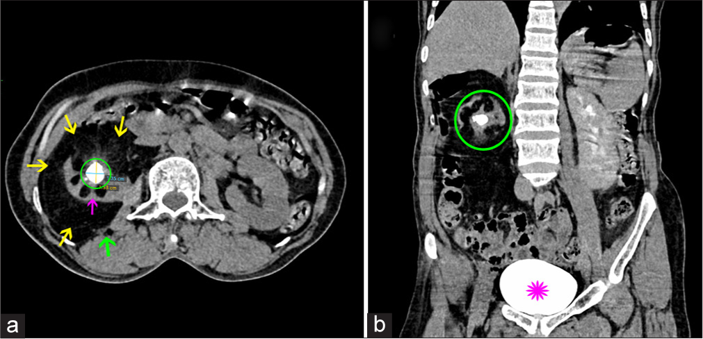 A 55-year-old female with right renal replacement lipomatosis. (a) Non-contrast computed tomography abdomen axial view at the level of L2 showing a large amount of fat tissue (yellow arrows) in renal sinus and surrounding atrophic right kidney (pink arrow) with central pelvic calculus (green circle). Also note the atrophy of the right psoas muscle (green arrow). (b) Contrast-enhanced computed tomography of the abdomen, coronal section after 1 h of contrast administration, showing lack of contrast excretion from the right kidney (green circle). Pink flower denotes the contrast-filled urinary bladder.
