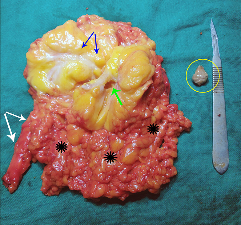 A 55-year-old female after undergoing laparoscopic right radical nephrectomy showing right kidney specimen along with upper ureter segment (shown by white arrows) and attached peri-renal fat (area depicted by black flowers). The blue arrows point to brightly yellow-colored proliferation of renal sinus fat. The stone (inside yellow circle) was extracted from the pelvis of the kidney (empty space marked by green arrow).